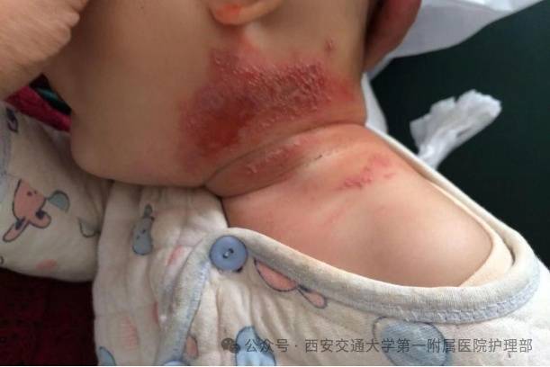 皇冠信用盘_西安多区发现隐翅虫？千万别拍皇冠信用盘！毒液堪比硫酸